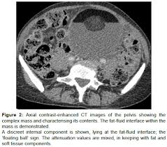 Yesturday i had keyhole surgery to remove what they thought was just a normal 6cm cyst on my right ovary. Squamous Cell Carcinoma In A Newly Diagnosed Ovarian Dermoid Cyst