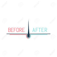 Vibendo brings fans and idols nearer than ever before. Hair Transplant Logo With A Follicle Before And After Concept Royalty Free Cliparts Vectors And Stock Illustration Image 137331654
