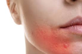 Mettez en avant votre expertise en aidant les autres ! Rougeurs Sur Le Visage Que Faire Pour Les Enlever