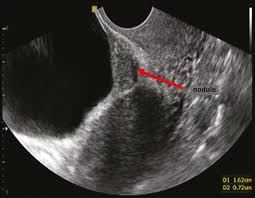 Maybe you would like to learn more about one of these? Scielo Brasil Transvaginal Ultrasound In Deep Endometriosis Pictorial Essay Transvaginal Ultrasound In Deep Endometriosis Pictorial Essay
