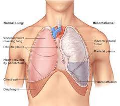 When it comes to monitoring your health, your heart and lungs are right at the top of the list of important organs you should focus on. Malignant Pleural Mesothelioma Department Of Cardiothoracic Surgery Stanford Medicine