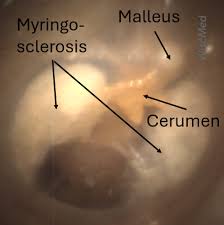 Image result for Myringosclerosis