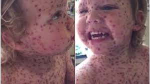 Jasper Allen, 2, seems in good spirits after being discharged