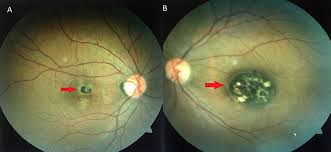 Image result for Coloboma