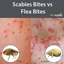 flea bites vs bed bug bites 1 bed bug bites psoriasis treatment bed bug bites pictures
