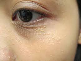 For some people, small raised white spots on face appear after shaving. Milia Small White Bumps On Face Skin Care Top News