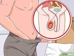 How To Treat Testicular Cancer: 15 Steps (With Pictures) - Wikihow