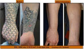 Most of our customers ask lots of questions about the process itself. Laser Tattoo Removal Training Iapam Aesthetic Medicine Symposium Botox Training Iapam Aesthetic Medicine Symposium