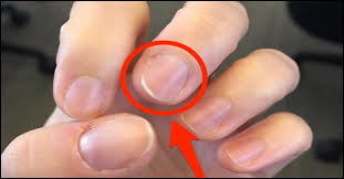 At first, the lines may be plumb colored but they then to darken with time so that in a couple of days, they become brown or. Effects Of Nutrient Deficiency On The Nails What Do They Indicate About Your Health