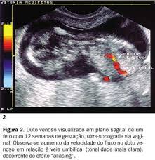 Radiologia Brasileira Dopplervelocimetria Do Duto Venoso No Calculo De Risco Para Sindrome De Down No Primeiro Trimestre Da Gravidez