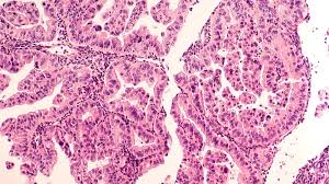 Discuss treatment options with your healthcare providers to decide what care you want to. Accelerating The Diagnosis And Treatment Of Cancer With Mass Spectrometry Based Techniques