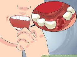 How To Heal Gums After A Tooth Extraction With Pictures Tooth Extraction Tooth Extraction Healing Wisdom Teeth Recovery