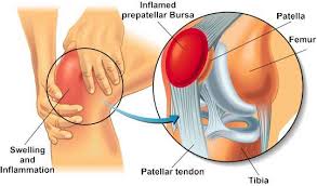 Image result for Bursitis