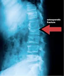 Image result for Vertebral Compression Fracture
