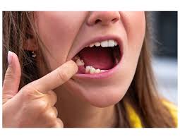 Image result for Dry Socket