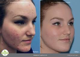 Blue Red Light Therapy Phoenix Skin Spa