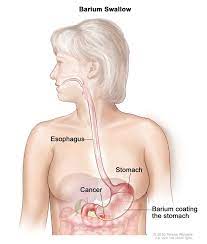 Stomach cancer can cause abdominal swelling, which can cause frequent bloating. Gastric Cancer Treatment Pdq Patient Version National Cancer Institute