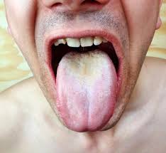 Image result for yellow tongue infection