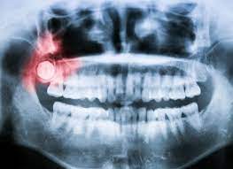 What Is An Impacted Wisdom Tooth Bowmanville Dental