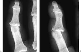 Image result for Lateral PIP Dislocation