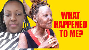 Naomi Fields has a rare condition that makes her skin “excruciatingly”  fragile, and her mum is sharing her story to send an important message to  other parents