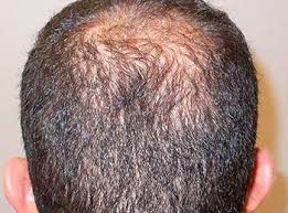 Isdin hair growth bundle for strong hair and volume boost lambdapil hair density shampoo lotion. Lambdapil Anti Hair Loss Complete Solution For Alopecia Isdin