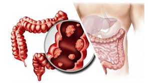 Image result for Colorectal Cancer