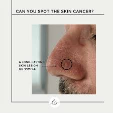 Image result for skin cancer on nose pimple