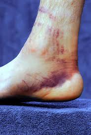 Download iate, european union, 2017. Blaue Flecken Darum Ist Ein Hamatom Nicht Immer Harmlos