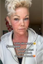 Transform Your Skin with CoolPeel Therapy in Florida