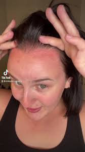 How to Care for Sunburnt Skin: Essential Tips and Remedies