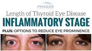 My swollen nose is not at all. How Long Thyroid Eye Disease Graves Disease Lasts And Reducing Eye Prominence Youtube