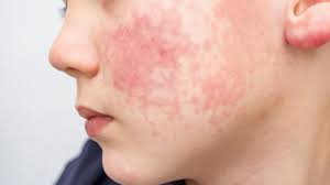 Image result for red rash face