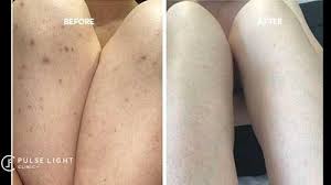 Why am i prone to this? answered by dr. Hollywood Laser Hair Removal Pulse Light Clinic London