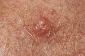 Sections show more follow today when marisha dotson looks in the mirror today, she struggles to recogn. Skin Cancer Image Gallery Pictures And Photos