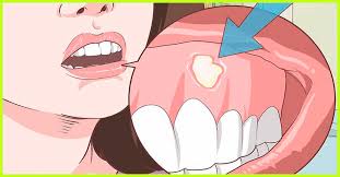 14 Home Remedies To Treat Swollen Gums Causes And Prevention