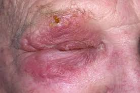 Image result for zoster under breasts