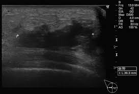 As a result, the cyst appears as a black spot in the ultrasound image. Inflammatory Breast Cancer Associated With Amyopathic Dermatomyositis A Case Report Surgical Case Reports Full Text