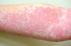 Chlamydia in males can give a penile discharge. Chlorine Rash Symptoms Causes And Treatment