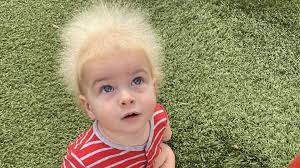 100 Confirmed Cases in the World': Boy Diagnosed With Rare Uncombable Hair  Syndrome