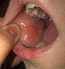 Image result for Erythroplakia roof of mouth