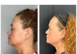 RKM Aesthetics and Wellness: Robert Moffatt, MD, 231 N Dos Caminos Ave,  Ventura, CA 93003, US