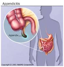 Related information on australian websites. Appendicitis Early Symptoms Causes Pain Location Surgery Recovery