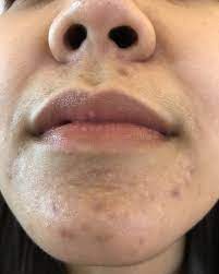 Untuk mencapai tujuan ini hampir seluruh wanita menggunakan lipstick untuk membuat bibir mereka tampak merah dan cerah. Bukan Jerawat Waspadai Herpes Yang Tumbuh Di Sekitar Bibir Hijab Dream Co Id