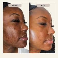 My acne journey has been a long and uncomfortable one. Finding my  confidence after struggling with acne for 10 years is so refreshing and it  feels so good 🥰 wishing this kind