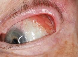 Image result for conjunctival melanoma