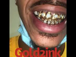 Permanent gold teeth atlanta ga. Open Face Permanent Looking Grillz Youtube