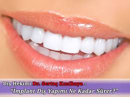 Bazı kişilerde doğuştan gelen bir bozukluk ya da sonradan meydana gelebilecek bir durumla diş yapısında bozukluk meydana gelebilmekte. Implant Dis Yapimi Ne Kadar Surer 2021 Indirimli Fiyat