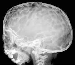The beaten copper appearance (bca) on skull radiographs is thought to correspond to the gyral pattern of the underlying brain  17 , and it is hypothesized that the continuous pulsatile pressure that the brain exerts on the cranium results in remodeling of the inner cranium, which manifests as bca on skull radiographs  6, 17 . Lumps Bumps And Funny Shaped Heads Adc Education Practice Edition