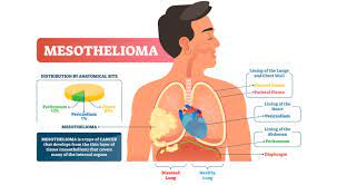 The majority of cases are pleural mesothelioma, which forms in the lining of the chest cavity, known as the pleura. What Is Mesothelioma Laws101 Com